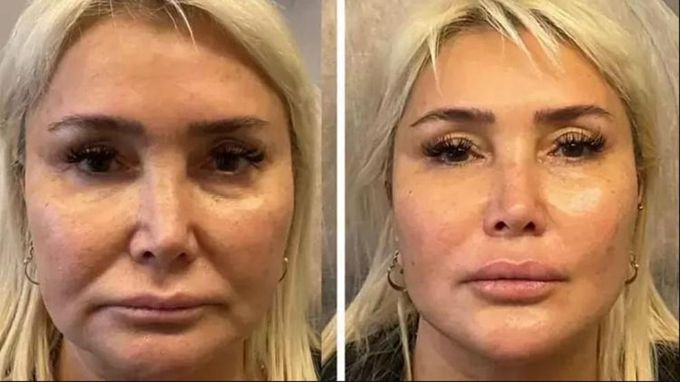 Yonca Evcimik estetik yaptırdı: 30 yaş gençleşmiş