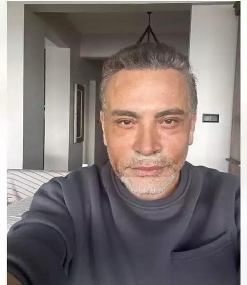 Cenk Erenin estetik faturası ortaya çıktı Fiyatı dudak uçuklattı
