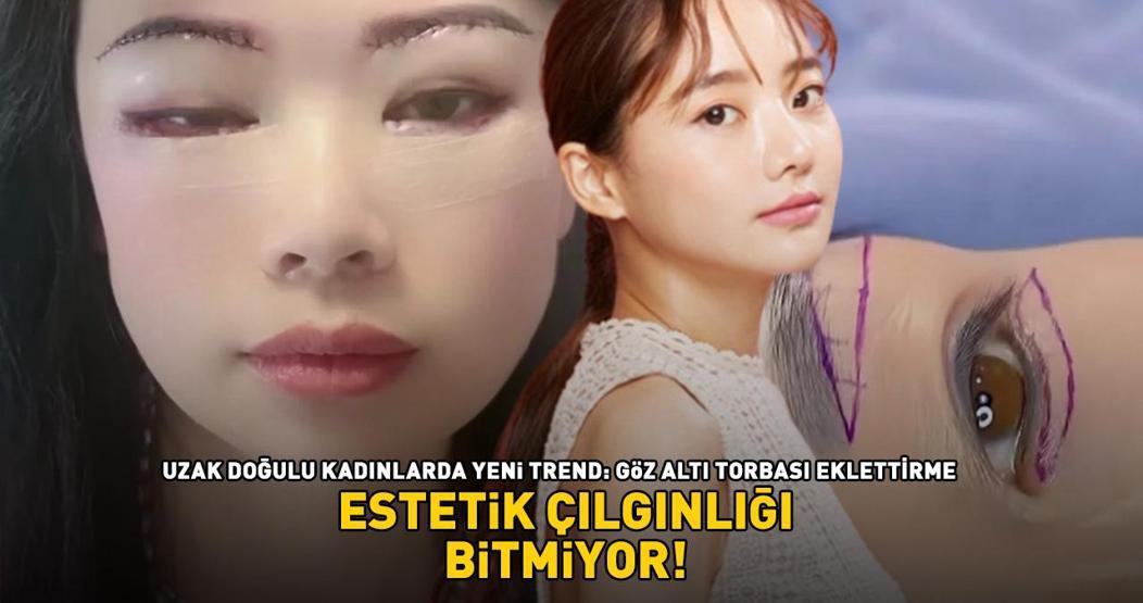 Estetik çılgınlığı bitmiyor Uzak Doğulu kadınların yeni gözdesi: Göz altı torbası eklettirme