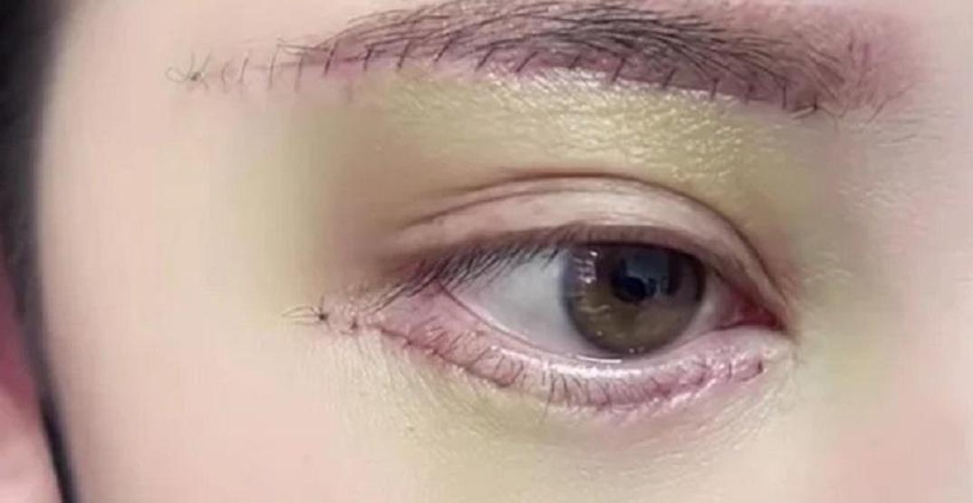 Estetik çılgınlığı bitmiyor Uzak Doğulu kadınların yeni gözdesi: Göz altı torbası eklettirme