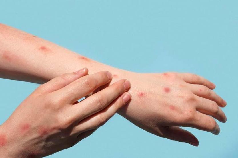 Uzmanı uyardı: Havuz suları el ayak ağız hastalığını bulaştırabilir