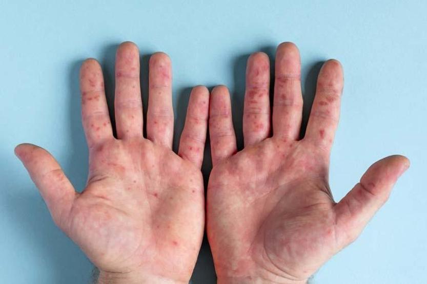 5 yaş altı çocukları daha çok etkiliyor Uzmanı uyardı, bu hastalık hafife alınmamalı