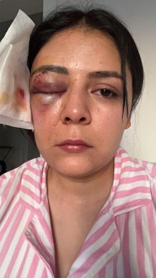 Yolda Yürürken Yumruklu Saldırıya Uğramıştı Genç Kadın Konuştu