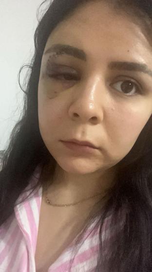 Yolda Yürürken Yumruklu Saldırıya Uğramıştı Genç Kadın Konuştu