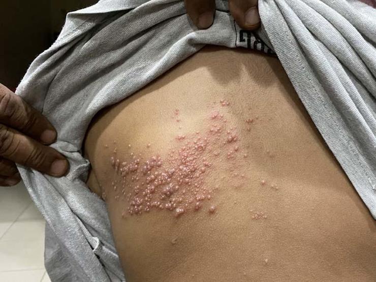 Aşırı stres tetikliyor Bağışıklığı zayıf bireylerde zona riski daha fazla