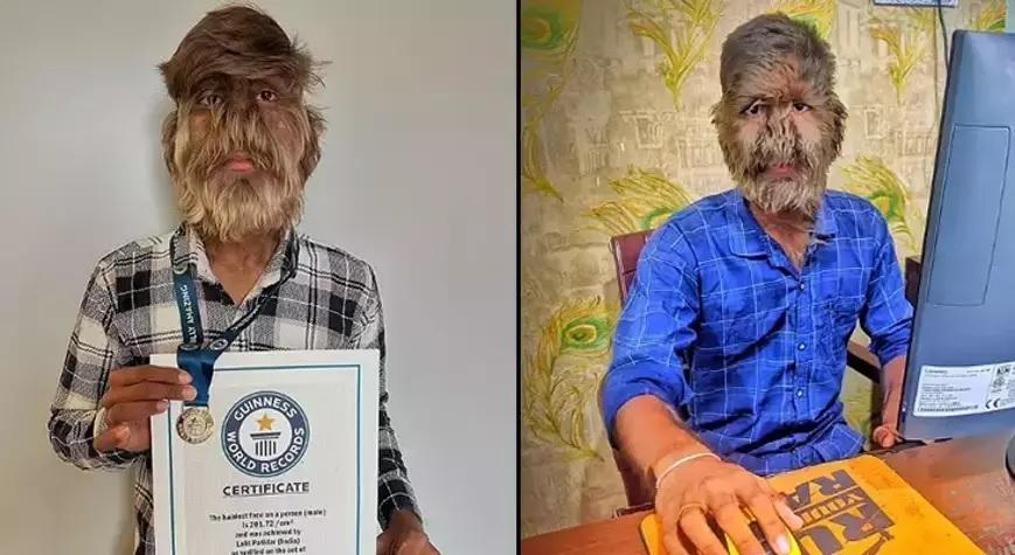 Hintli kurt adam Guinnesse girdi Milyarda bir görülen hastalık Yüzünün yüzde 95i...