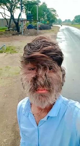 Hintli kurt adam Guinnesse girdi Milyarda bir görülen hastalık Yüzünün yüzde 95i...