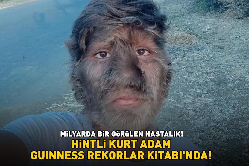 Hintli kurt adam Guinnesse girdi Milyarda bir görülen hastalık Yüzünün yüzde 95i...