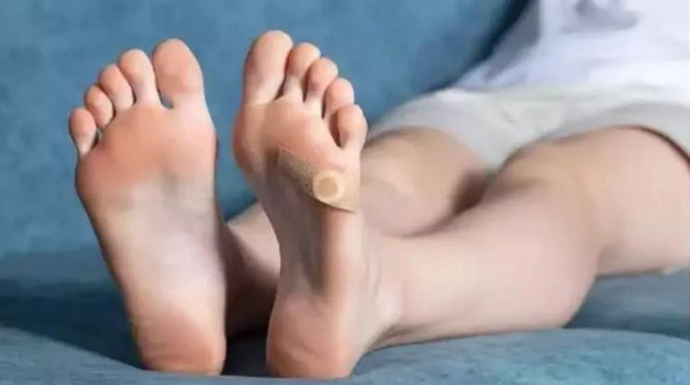 Ayaklarda oluşan nasırlara dikkat O hastalığın habercisi olabilir