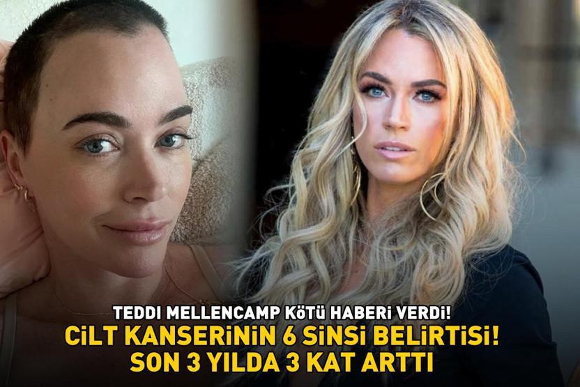 CİLT KANSERİNİN 6 SİNSİ BELİRTİSİ Teddi Mellencamp kötü haberi verdi Aman dikkat Son 10 yıl içinde 3 kat arttı