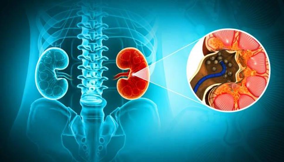 Uzmanı uyardı: Böbrek taşı sessiz ilerleyebilir