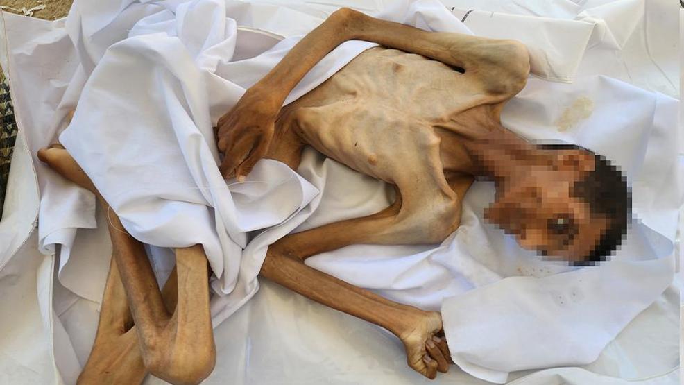 İsrail ablukasında Gazzede korkunç insani kriz: 27 yaşındaki genç yetersiz beslenme nedeniyle yaşamını yitirdi