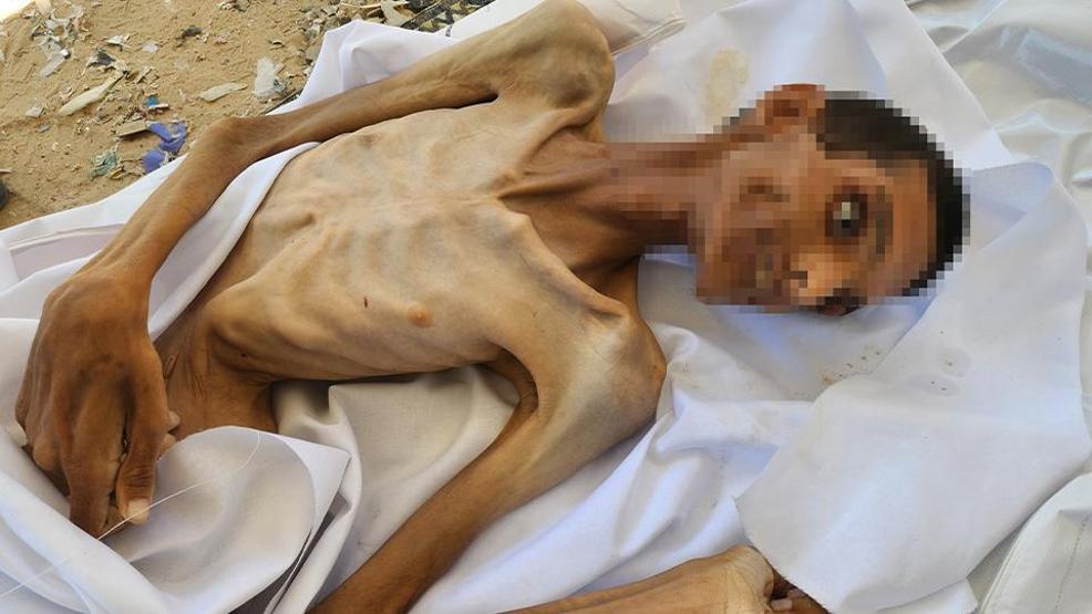İsrail ablukasında Gazzede korkunç insani kriz: 27 yaşındaki genç yetersiz beslenme nedeniyle yaşamını yitirdi