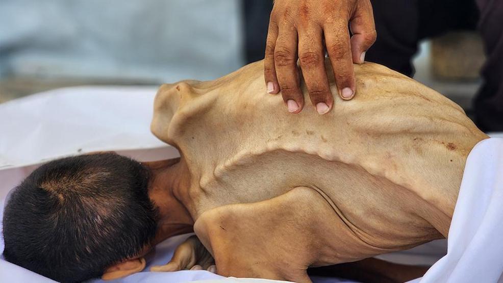 İsrail ablukasında Gazzede korkunç insani kriz: 27 yaşındaki genç yetersiz beslenme nedeniyle yaşamını yitirdi