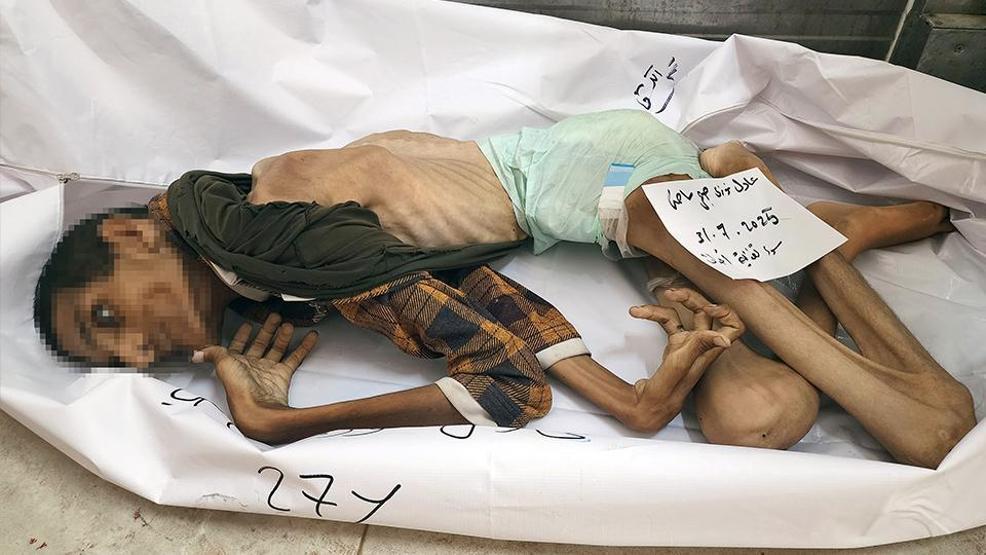 İsrail ablukasında Gazzede korkunç insani kriz: 27 yaşındaki genç yetersiz beslenme nedeniyle yaşamını yitirdi