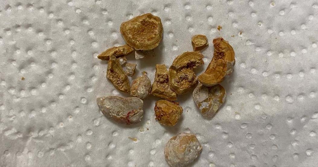 BÖBREK TAŞININ BİR NUMARALI DÜŞMANI Günde 1 Adet Suyun İçine Ekleyip İçin... Demli Çay Tiryakilerine de Önemli Uyarı