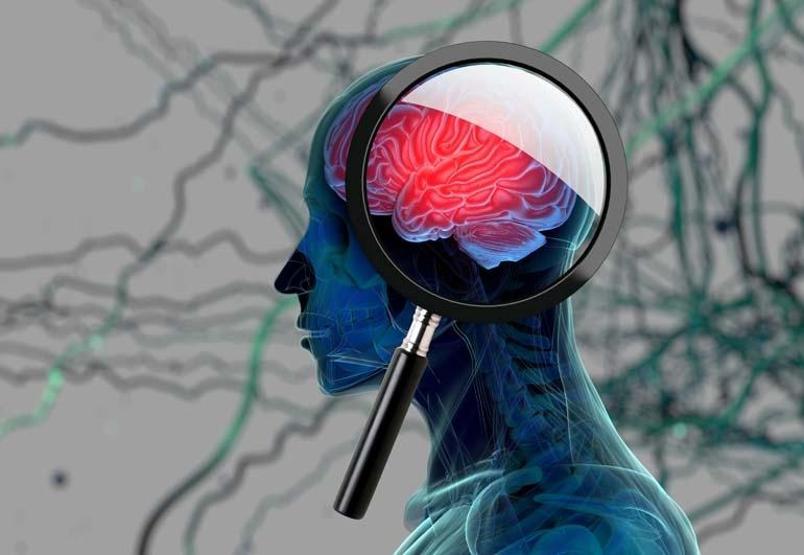 Beyin kan akımının azalması Alzheimer riskini artırıyor Alzheimera karşı en etkili yöntem...