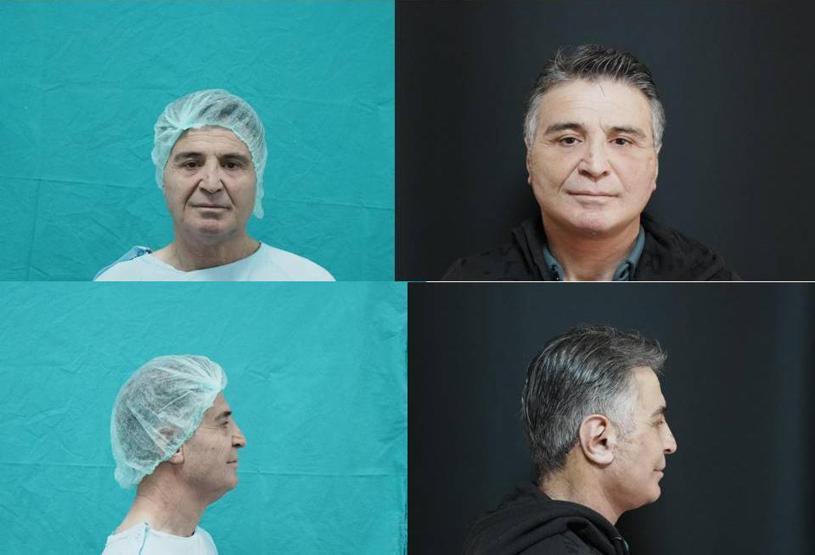 DEVLET HASTANESİNDE BİR İLK 15 yıl gençleşti