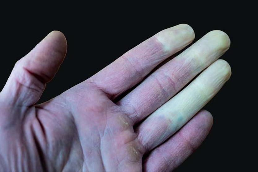 El ve Ayaklarda Aniden Oluşan Mavi-Mor Renk Değişimleri Bu Hastalığın Habercisi En Sık Bu Kişilerde Görülüyor