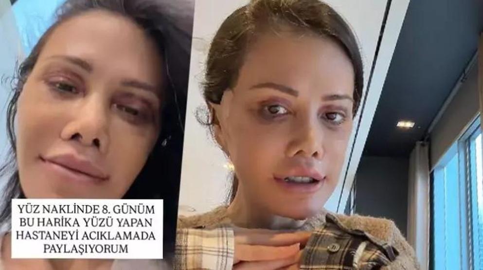 Didem Ceranın Yüz Nakli Macerası: Güney Korede Estetik Devrimi
