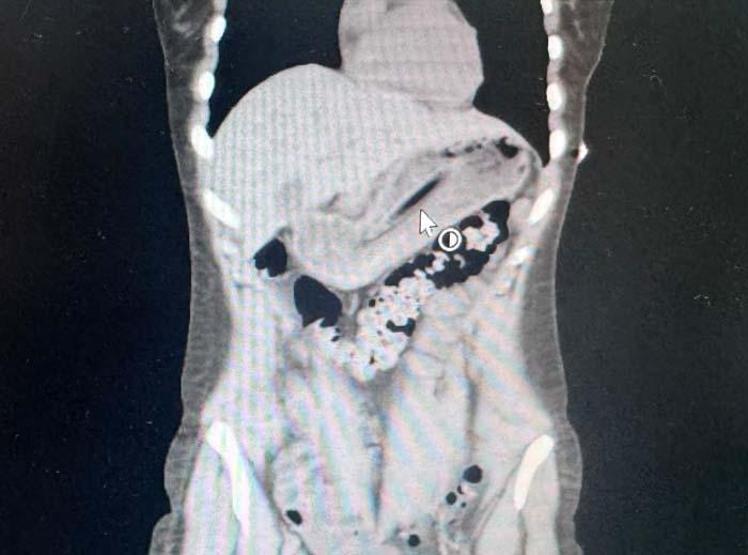 Zayıflamak İsterken Kabusu Yaşadı: Midesinden 13 Santimetrelik Diş Fırçası Çıktı... İşte Doktorları Şaşkına Çeviren Olay