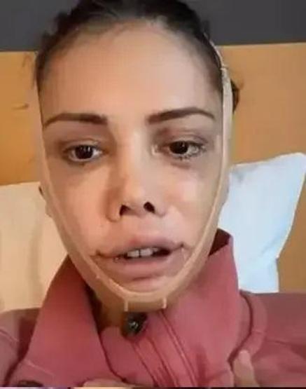 Yüz nakli olan Survivor Didem Ceran, bir kez daha bıçak altına yattı Gözyaşlarını tutamadı