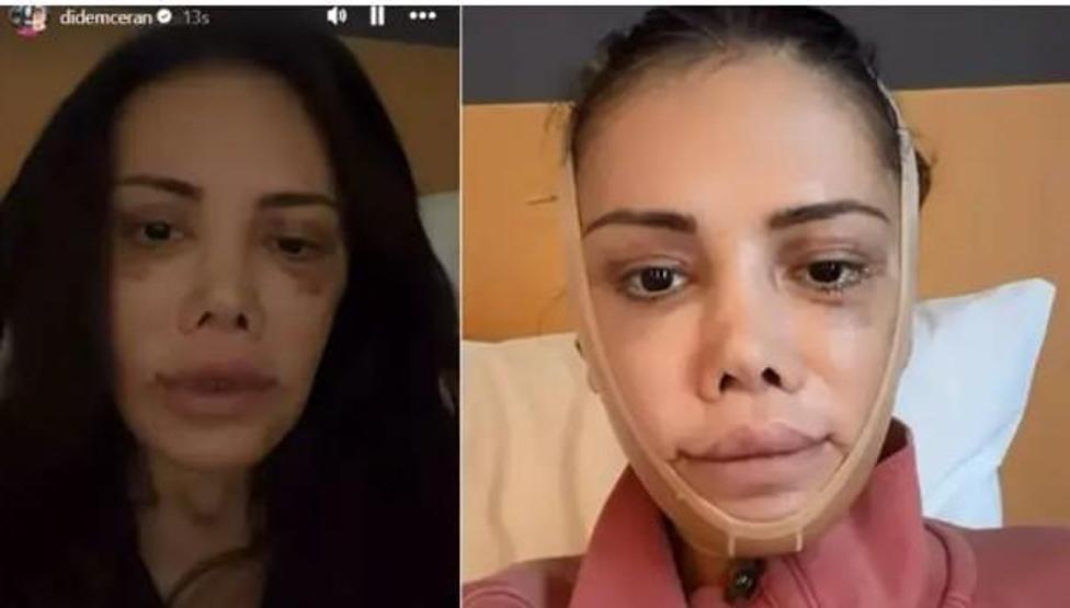 İkinci kez kapsamlı yüz operasyonu geçirmişti Didem Cerandan duygusal paylaşım: En iyi niyetli olduğum yerlerden cezalandırıldım