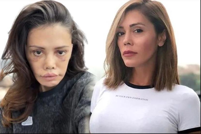 Yüzünde komplikasyon gelişti Didem Cerandan korkutan açıklama: Yeniden ameliyata girebilirim