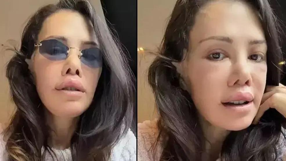 Yeni Görüntüleri Gündem Olmuştu Yüz Nakli Olan Didem Ceran İsyan Etti: Beni CİMER’e Şikayet Etmişler