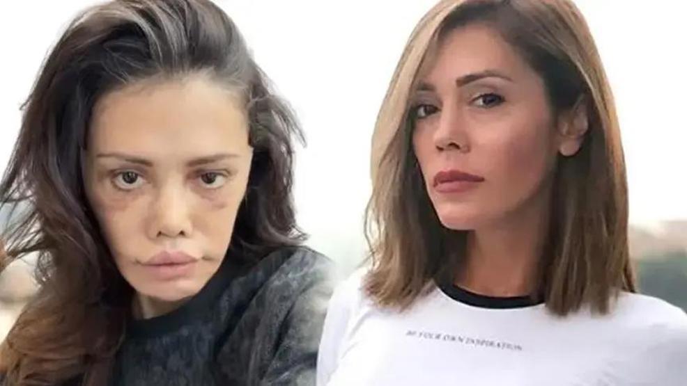 Yeni Görüntüleri Gündem Olmuştu Yüz Nakli Olan Didem Ceran İsyan Etti: Beni CİMER’e Şikayet Etmişler