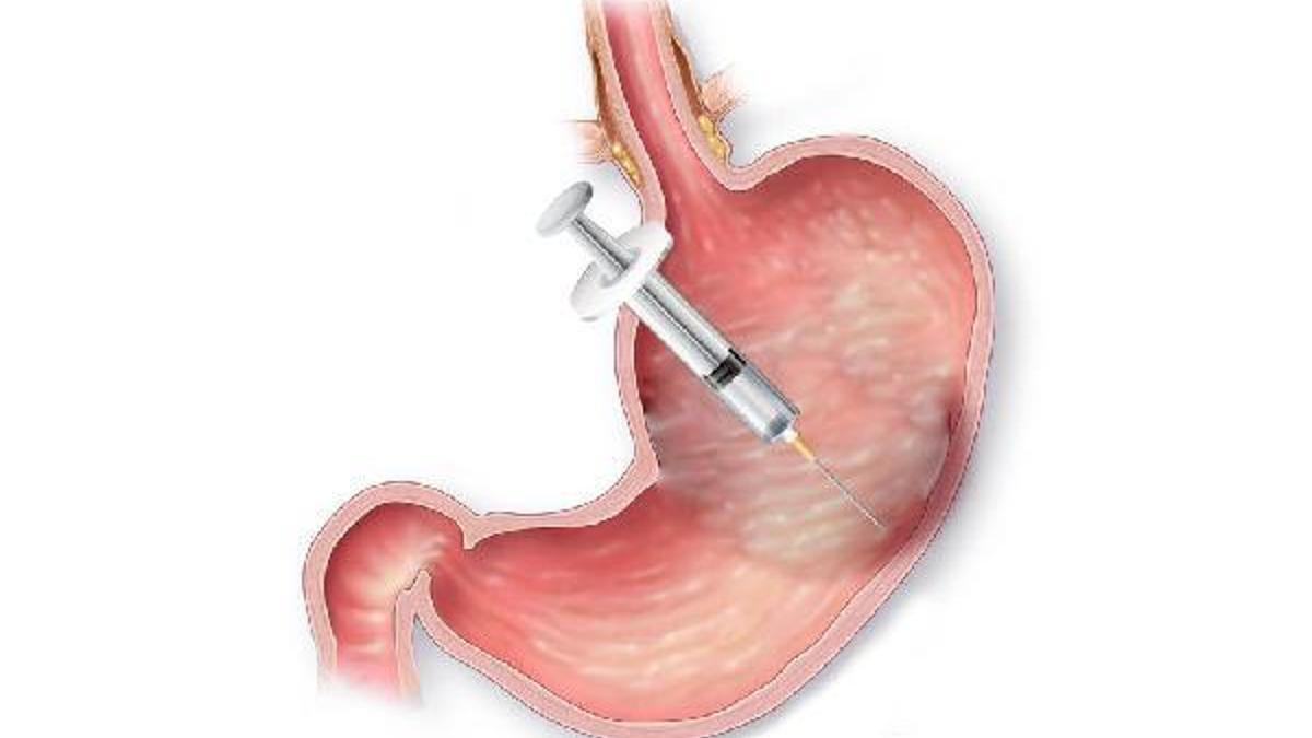 Kilolarınızdan mide botoksu ile kurtulun - Sağlık Haberleri.