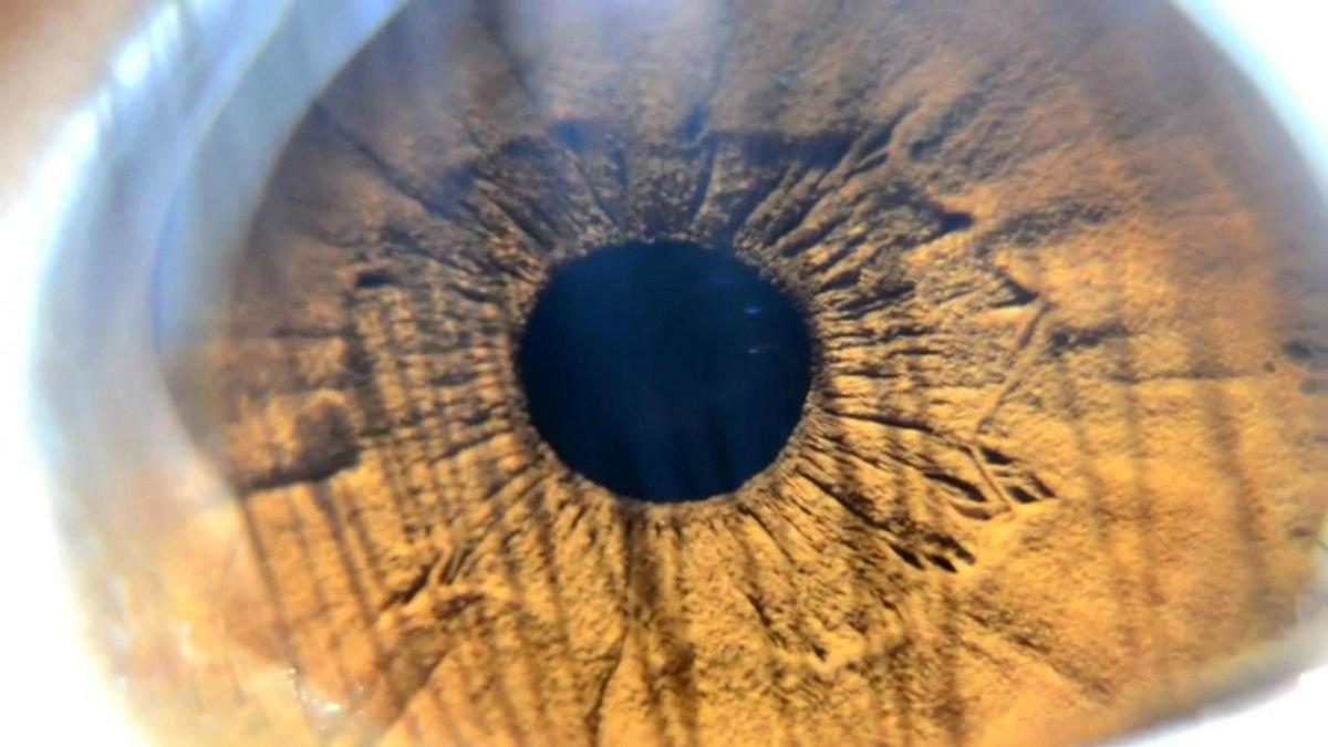 Yeni trend göz rengi değiştirme ameliyatı - Sağlık Haberleri