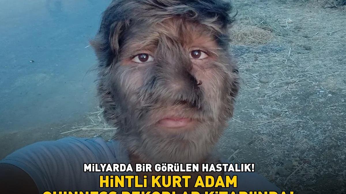 Hintli kurt adam Guinness'e girdi! Milyarda bir görülen hastalık ...