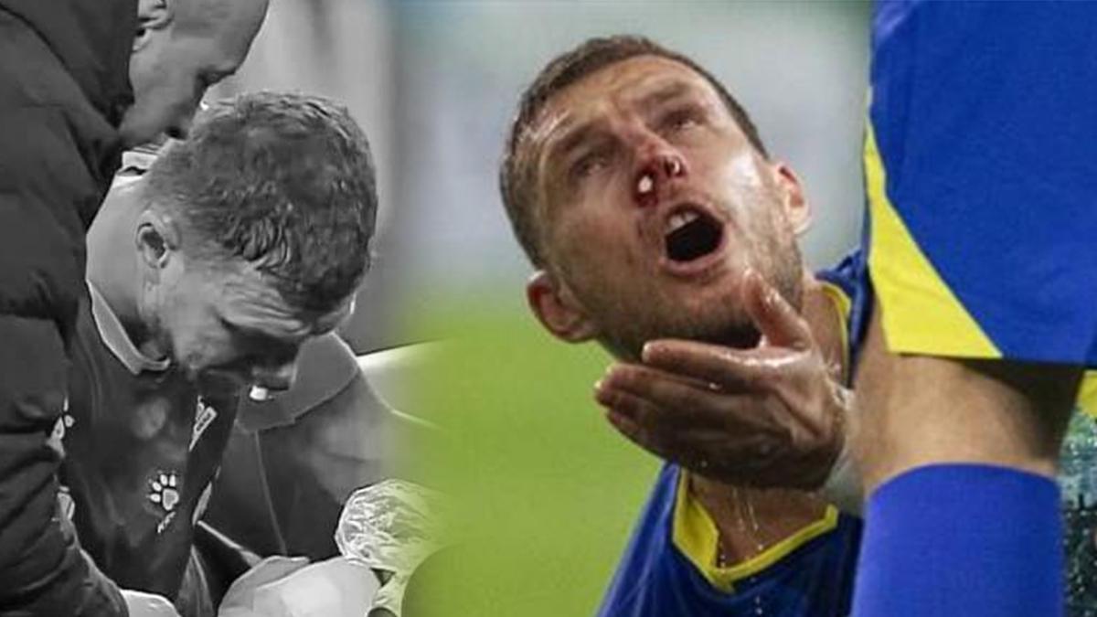 Fenerbahçe Kaptanı Edin Dzeko’nun burnu kırıldı