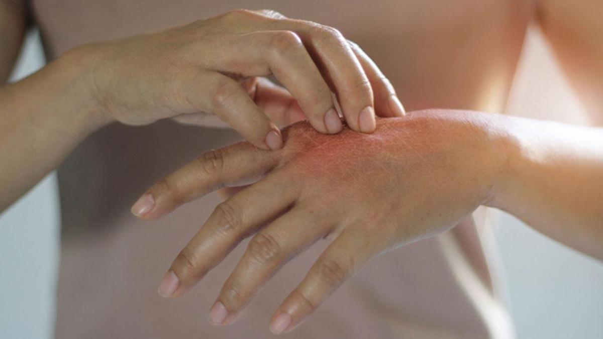 Egzama Nedir? Egzama Belirtileri, Nedenleri ve Etkili Tedavi Yöntemleri