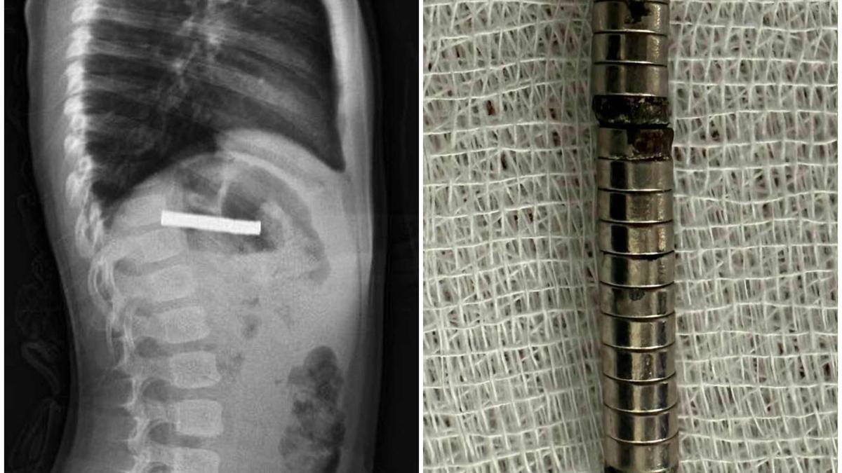 Şoke eden görüntü! 3 yaşındaki çocuğun yemek borus…