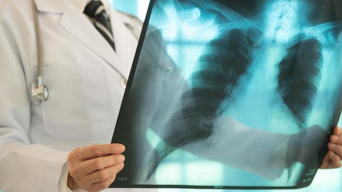 Erken tanı hayati önem taşıyor! Akciğer kanserinin belirtileri ne? Öksürük, göğüs ağrısı, halsizlik, kanlı balgam...