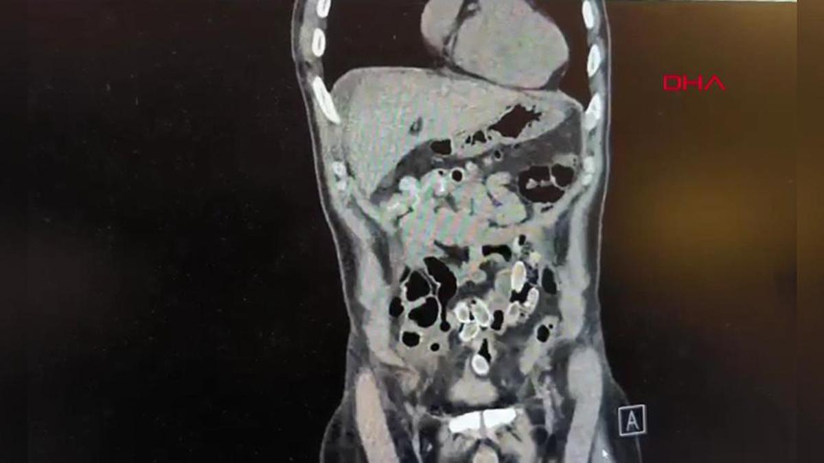 Midesinde paket paket uyuşturucu taşıdı