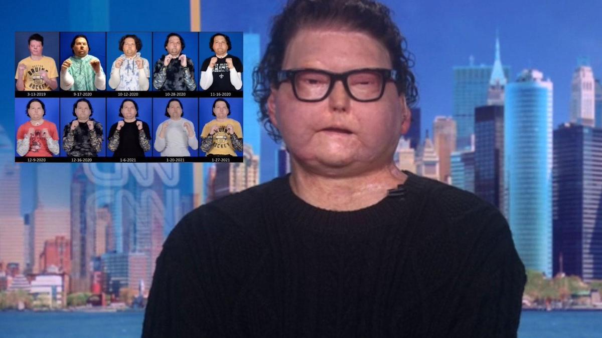 Yüz ve çift el nakli ile tıp tarihine geçmişti! Yaşadıklarını bu sözlerle anlattı: Yürümeyi tekrardan öğrenmem gerekti