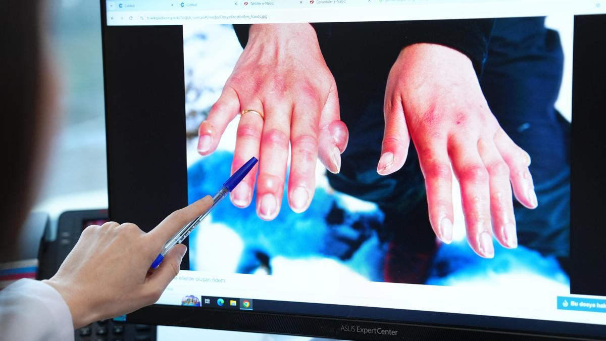 Kış aylarında soğuk ısırığı vakaları artıyor