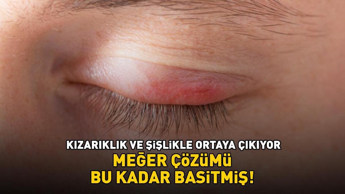 Göz kapağı iltihabına ne iyi gelir? Kızarıklık ve şişlikle ortaya çıkıyor! Meğer çözümü bu kadar basitmiş
