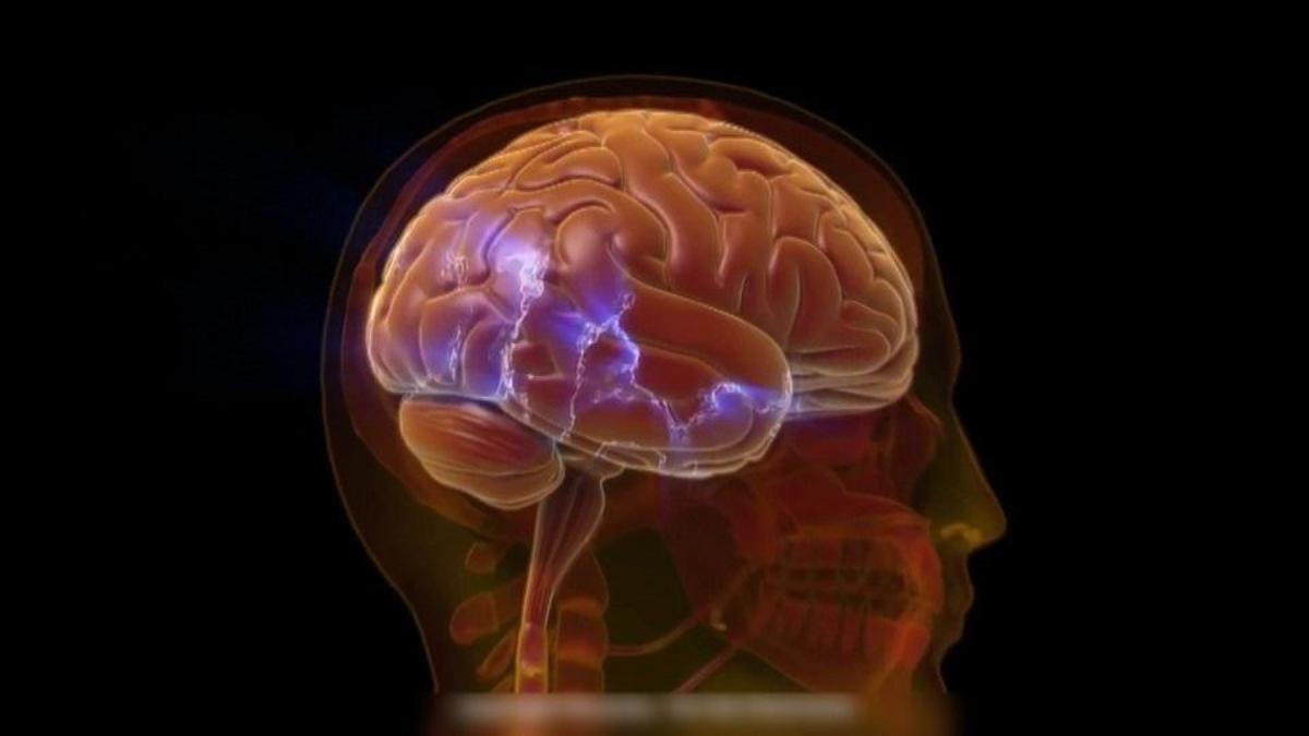 Türkiye'den sonra şimdi de Hollanda... Ameliyattan sonra ana dilini unuttu!