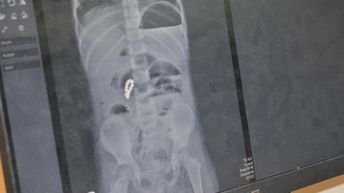 4 yaşındaki Edanın bağırsağından 8 adet mıknatıslı boncuk çıkarıldı