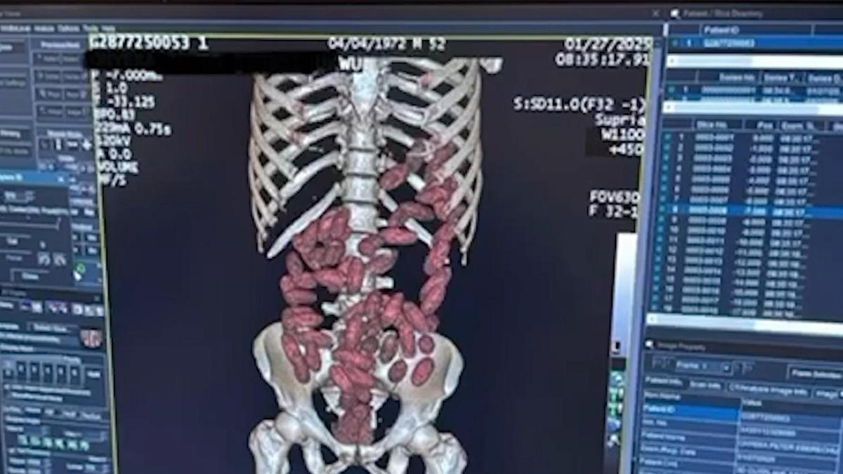 İstanbul- 2025te İstanbul Havalimanında yutucu kuryelerden 29,7 kilo uyuşturucu ele geçirildi