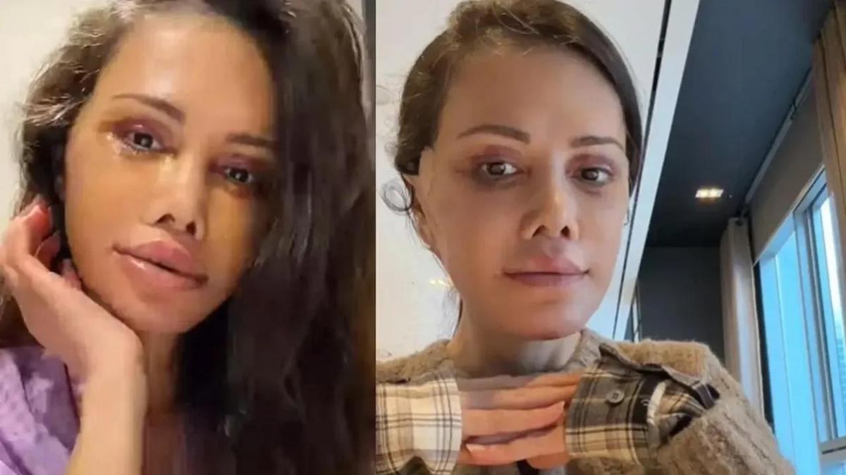 Yüz Nakli Yaptırmıştı! Eski Survivor Yarışmacısı Didem Ceran Son Halini Paylaştı