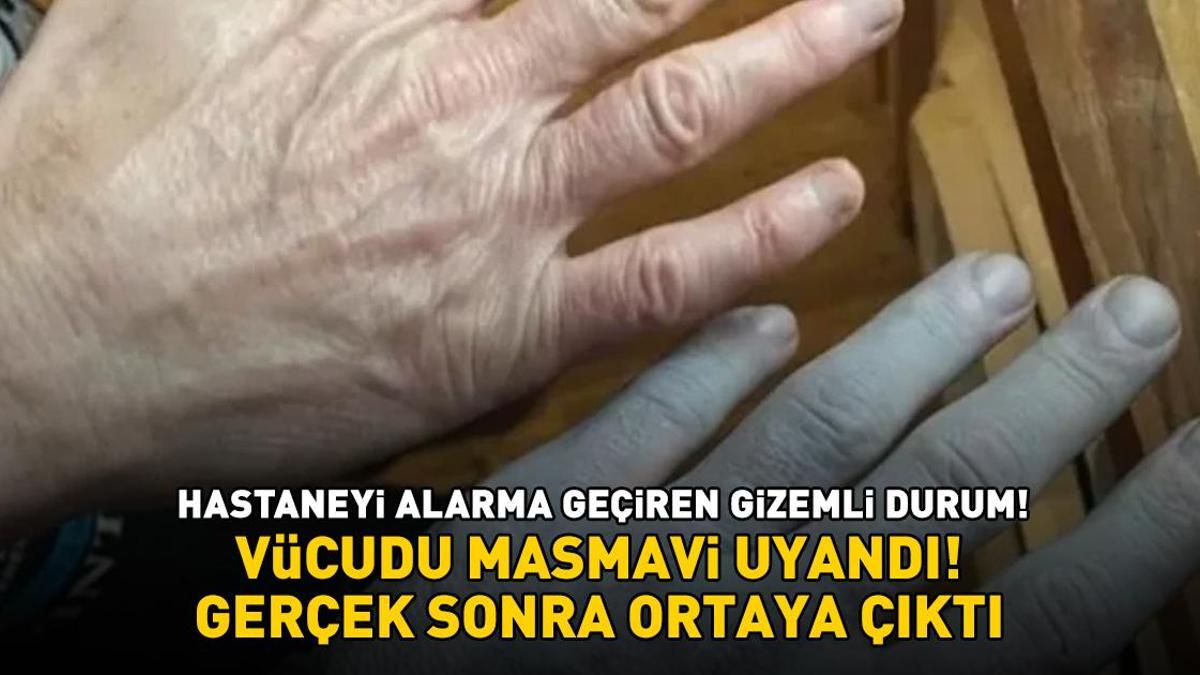 Hastaneyi alarma geçiren gizemli durum! Vücudu masmavi uyandı! Gerçek sonra ortaya çıktı