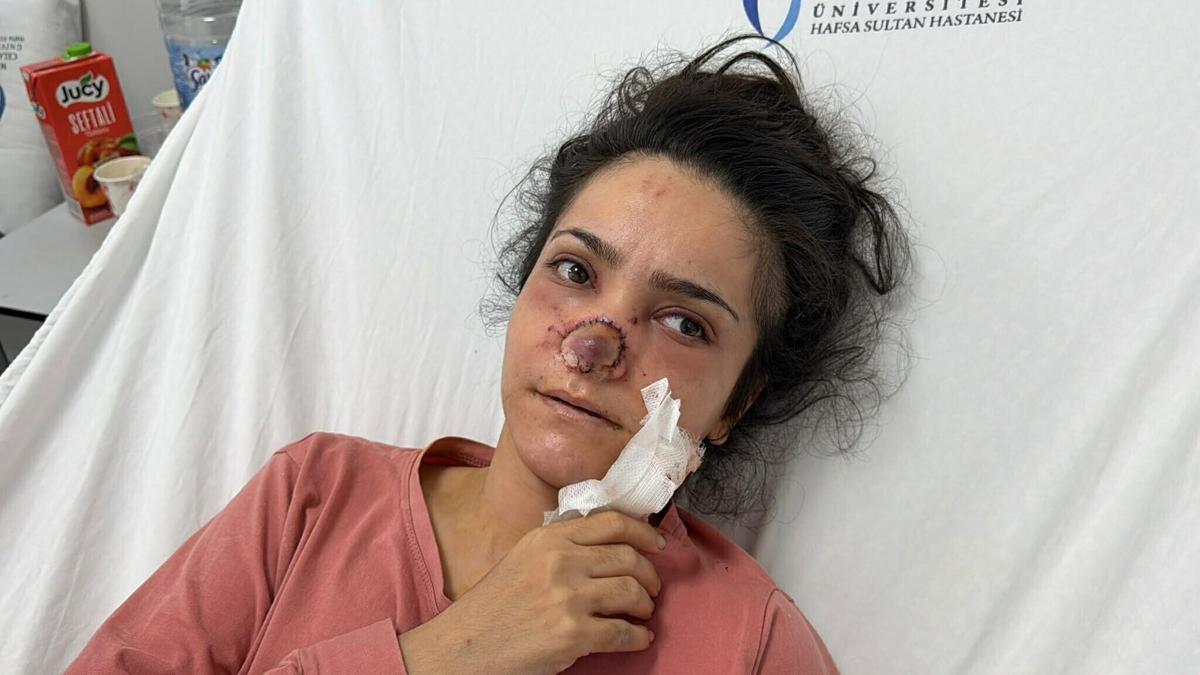 Eşi tarafından burnu ısırılıp koparılan İmran: Canımın acıyla balkondan atlamayı bile düşündüm haber görseli