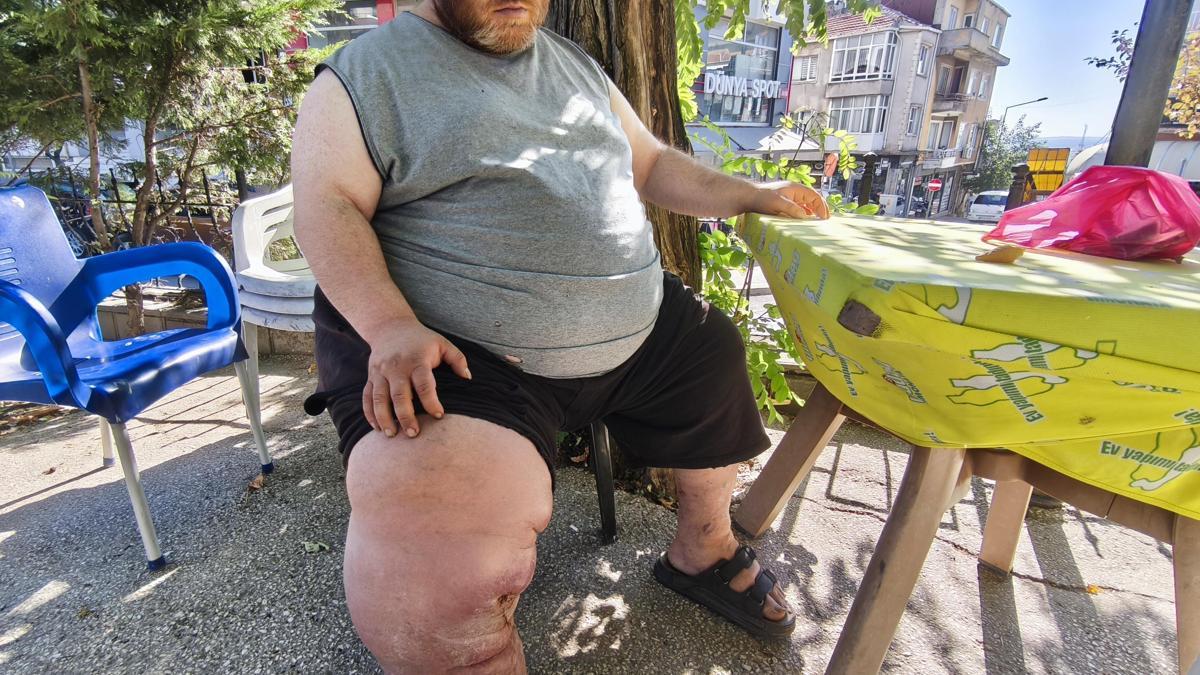 Fil hastası Kazım'ın tedavi olabilmesi için 82 kilo vermesi gerekiyor