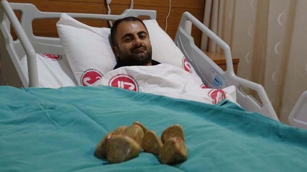 Akıl alır gibi değil Bunların hepsi ameliyatla vücudundan çıkartıldı... Akıl alır gibi değil Bunların hepsi ameliyatla vücudundan çıkartıldı...