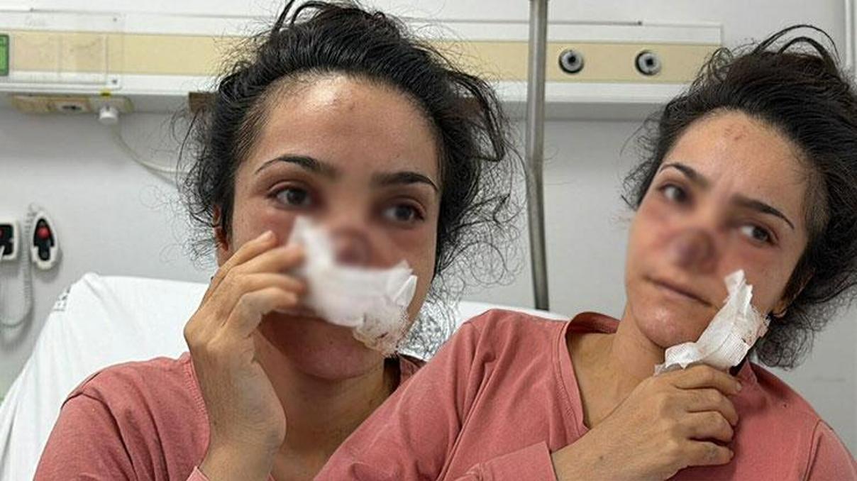 Eşi tarafından burnu ısırılıp koparılan kadın konuştu: Acıyla balkondan atlamayı bile düşündüm Eşi tarafından burnu ısırılıp koparılan kadın konuştu: Acıyla balkondan atlamayı bile düşündüm